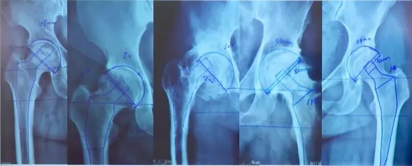 做好初次髋关节置换，这些技巧你掌握了吗？