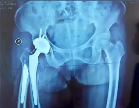 做好初次髋关节置换，这些技巧你掌握了吗？