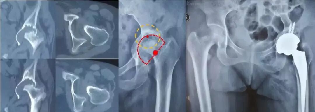 做好初次髋关节置换，这些技巧你掌握了吗？