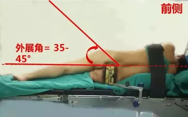 做好初次髋关节置换，这些技巧你掌握了吗？