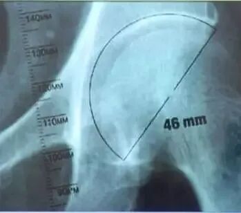 做好初次髋关节置换，这些技巧你掌握了吗？