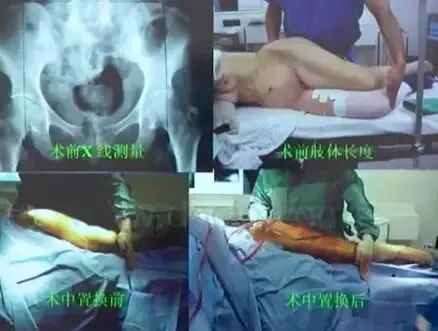 做好初次髋关节置换，这些技巧你掌握了吗？