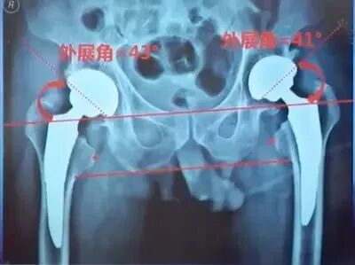 做好初次髋关节置换，这些技巧你掌握了吗？