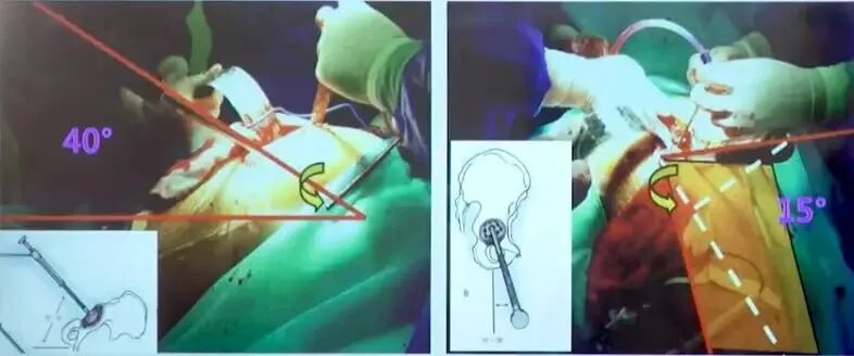 做好初次髋关节置换，这些技巧你掌握了吗？