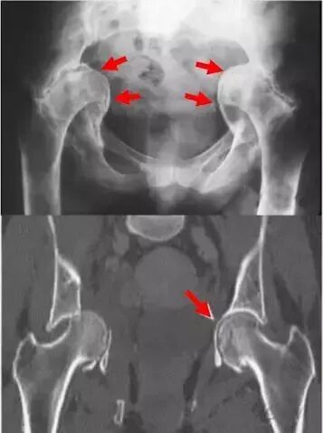 做好初次髋关节置换，这些技巧你掌握了吗？