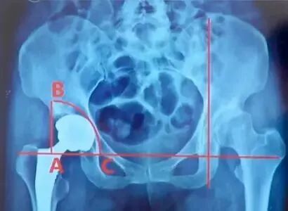 做好初次髋关节置换，这些技巧你掌握了吗？