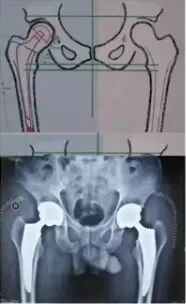 做好初次髋关节置换，这些技巧你掌握了吗？