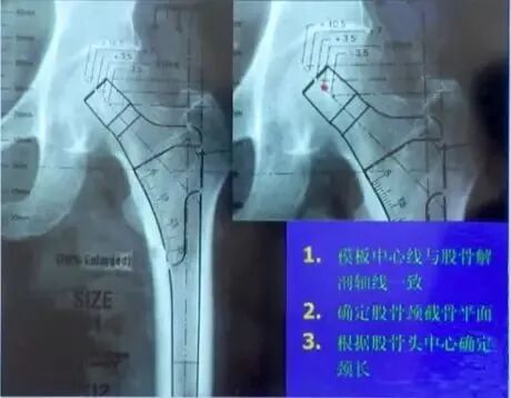 做好初次髋关节置换，这些技巧你掌握了吗？