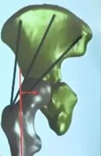 做好初次髋关节置换，这些技巧你掌握了吗？