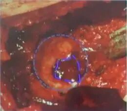 做好初次髋关节置换，这些技巧你掌握了吗？