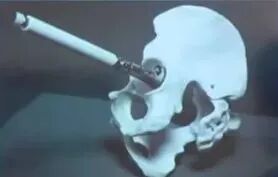 做好初次髋关节置换，这些技巧你掌握了吗？