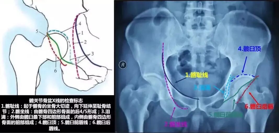 做好初次髋关节置换，这些技巧你掌握了吗？