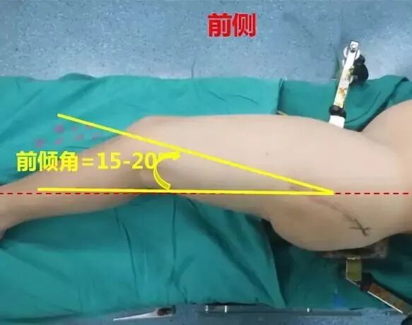 做好初次髋关节置换，这些技巧你掌握了吗？