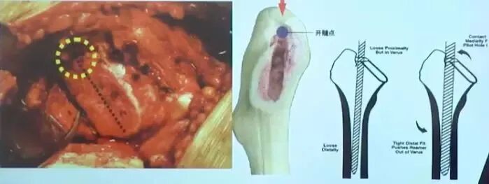 做好初次髋关节置换，这些技巧你掌握了吗？