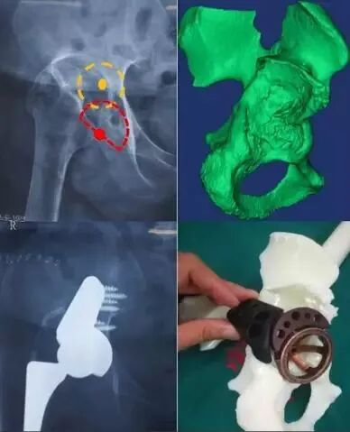 做好初次髋关节置换，这些技巧你掌握了吗？