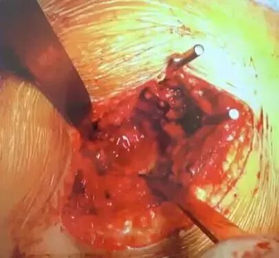 做好初次髋关节置换，这些技巧你掌握了吗？