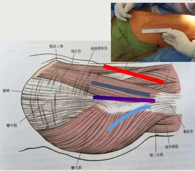 做好初次髋关节置换，这些技巧你掌握了吗？