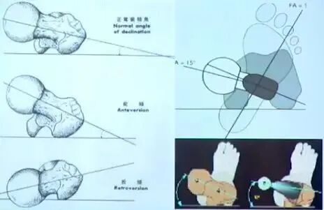 做好初次髋关节置换，这些技巧你掌握了吗？