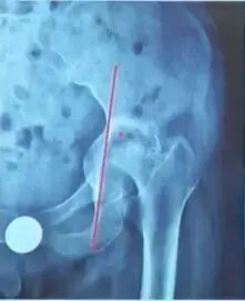 做好初次髋关节置换，这些技巧你掌握了吗？