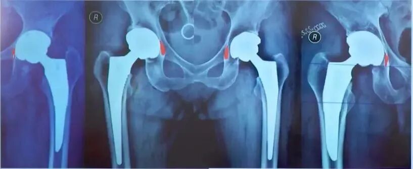 做好初次髋关节置换，这些技巧你掌握了吗？