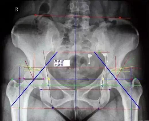 做好初次髋关节置换，这些技巧你掌握了吗？