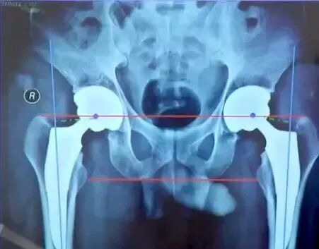 做好初次髋关节置换，这些技巧你掌握了吗？