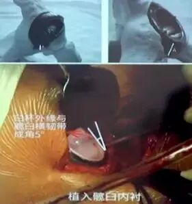 做好初次髋关节置换，这些技巧你掌握了吗？