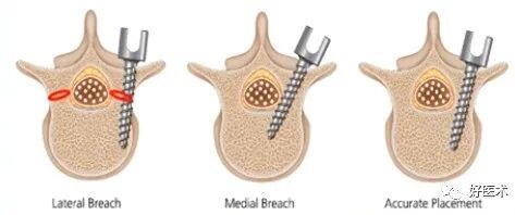 快准稳置入腰椎椎弓根螺钉，这些方法技巧你都掌握了吗？
