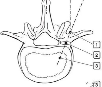 快准稳置入腰椎椎弓根螺钉，这些方法技巧你都掌握了吗？