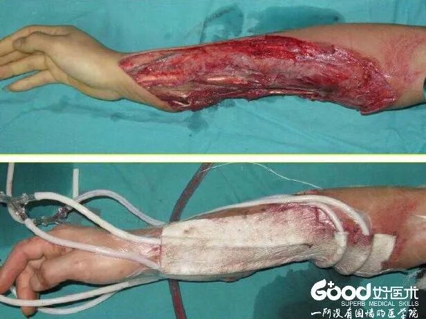 为什么负压引流用负压封闭引流技术，这里有一份图文教程！_https://www.jmylbn.com_新闻资讯_第2张