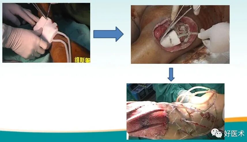 为什么负压引流用负压封闭引流技术，这里有一份图文教程！_https://www.jmylbn.com_新闻资讯_第4张