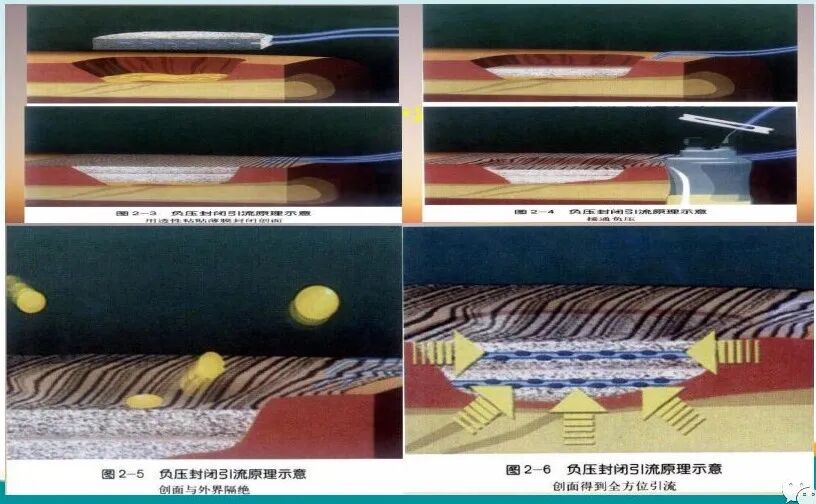 为什么负压引流用负压封闭引流技术，这里有一份图文教程！_https://www.jmylbn.com_新闻资讯_第3张