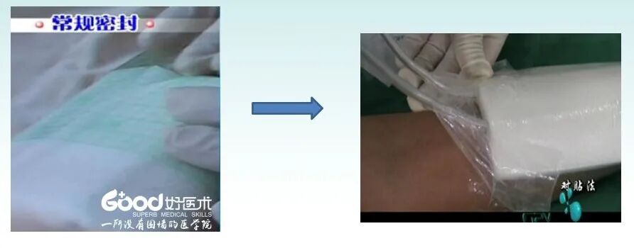 为什么负压引流用负压封闭引流技术，这里有一份图文教程！_https://www.jmylbn.com_新闻资讯_第5张