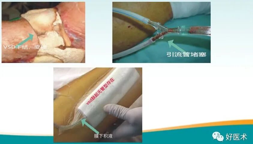 为什么负压引流用负压封闭引流技术，这里有一份图文教程！_https://www.jmylbn.com_新闻资讯_第6张