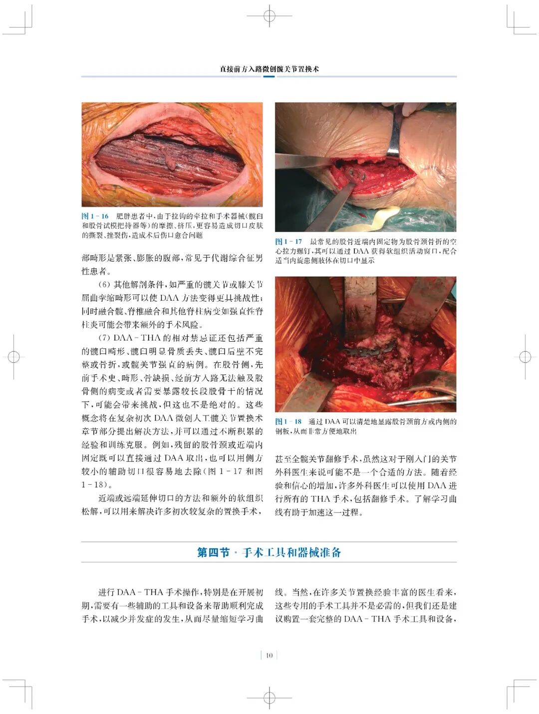 手术头灯眼镜怎么实用专著 ｜ 国内首部介绍直接前方入路微创髋关节置换术书籍_https://www.jmylbn.com_新闻资讯_第11张