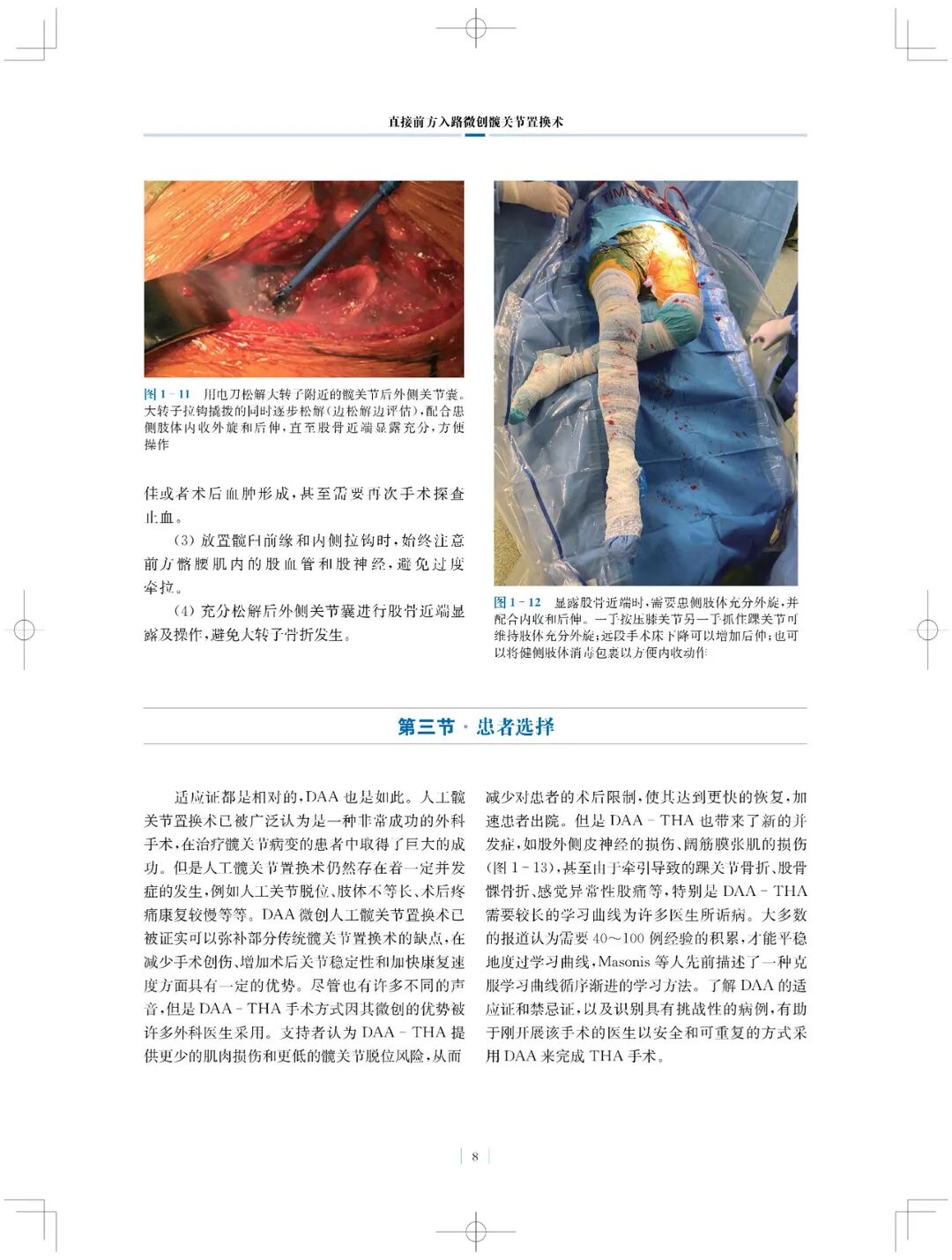 手术头灯眼镜怎么实用专著 ｜ 国内首部介绍直接前方入路微创髋关节置换术书籍_https://www.jmylbn.com_新闻资讯_第10张