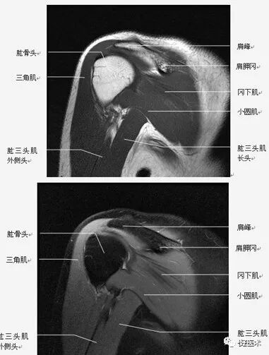 高清影像图解肩关节解剖及诊断