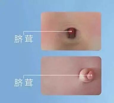 愈脐带怎么用视频断开生命的桥梁，爱依然在—谈谈新生儿脐部那些事_https://www.jmylbn.com_新闻资讯_第5张