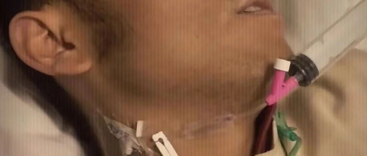 被蚊子咬进ICU