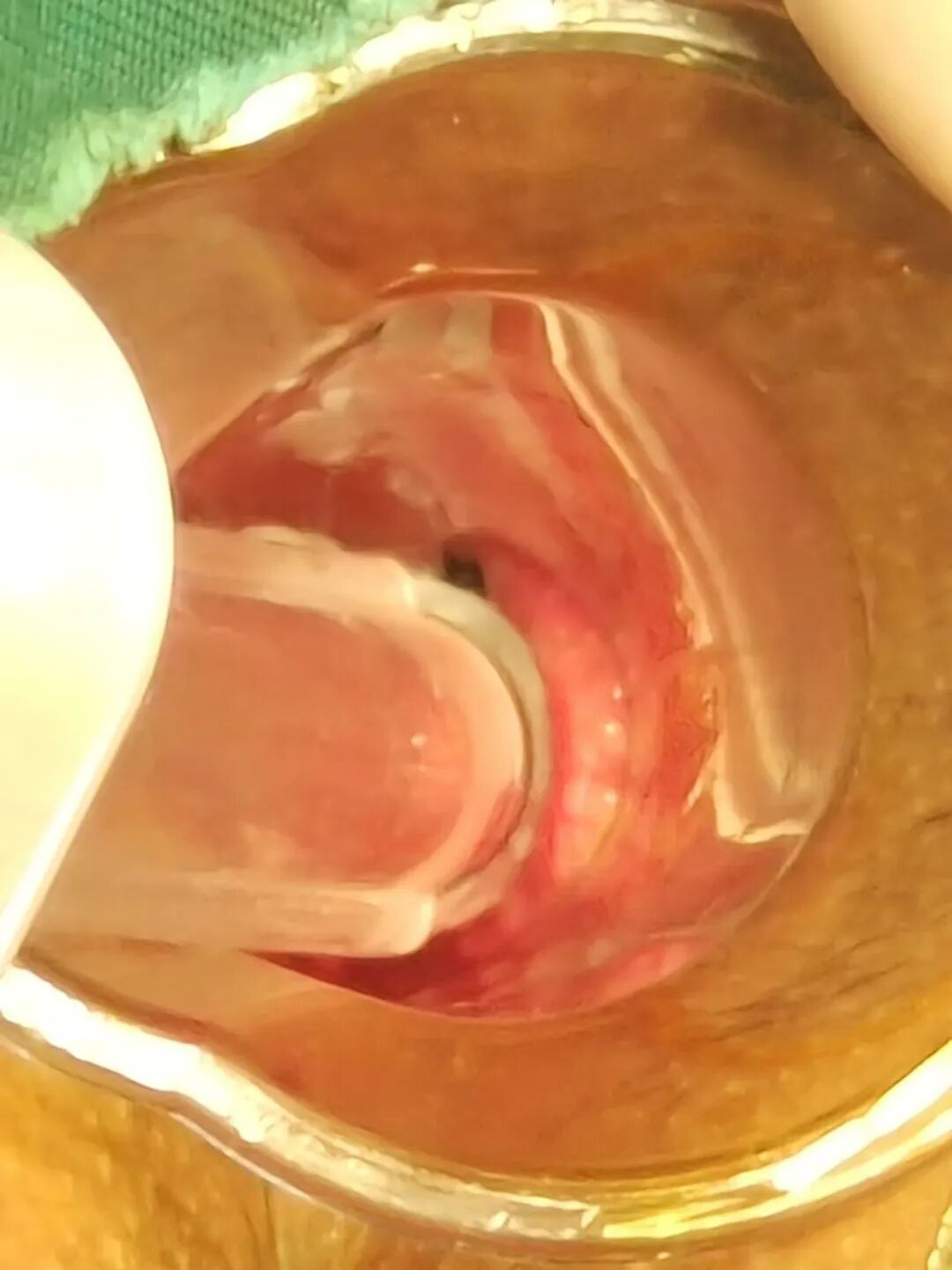 痔疮套扎吻合器怎么用【藤县人民医院健康小讲堂】普外二科：痔套扎术——痔患者的一个优选择_https://www.jmylbn.com_新闻资讯_第5张