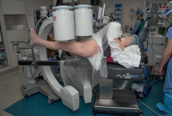 什么是c型臂术中透视骨科精读 ｜ 股骨近端骨折的转子区域与矢状面力线术中透视技巧_https://www.jmylbn.com_新闻资讯_第29张