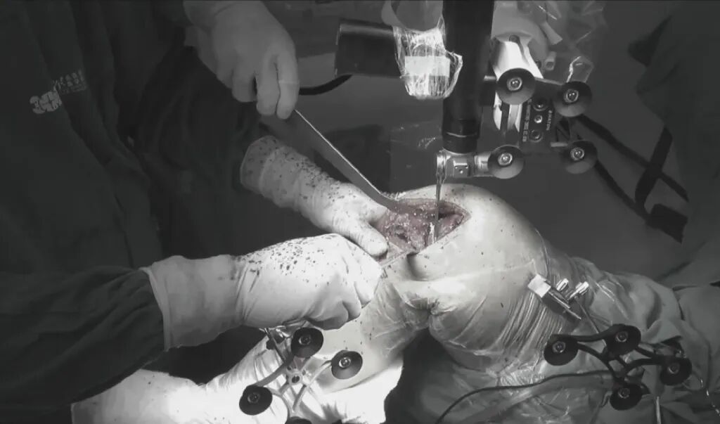 为什么骨科用摆锯首例！全自动摆锯智能巡航截骨机器人辅助膝关节单髁置换手术_https://www.jmylbn.com_新闻资讯_第1张