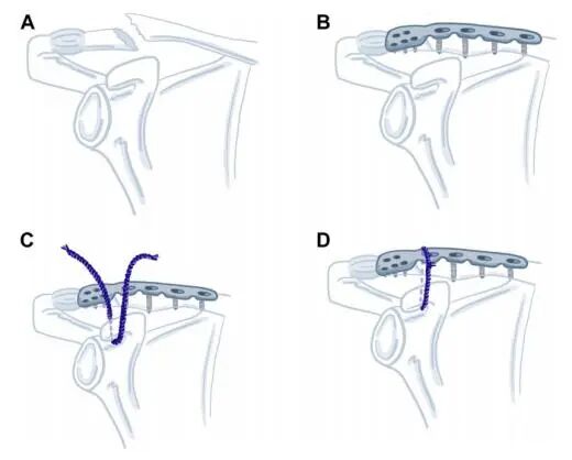 小儿的PDS怎么缝的一条缝线改善锁骨远端不稳定骨折固定效果，简单实用_https://www.jmylbn.com_新闻资讯_第1张