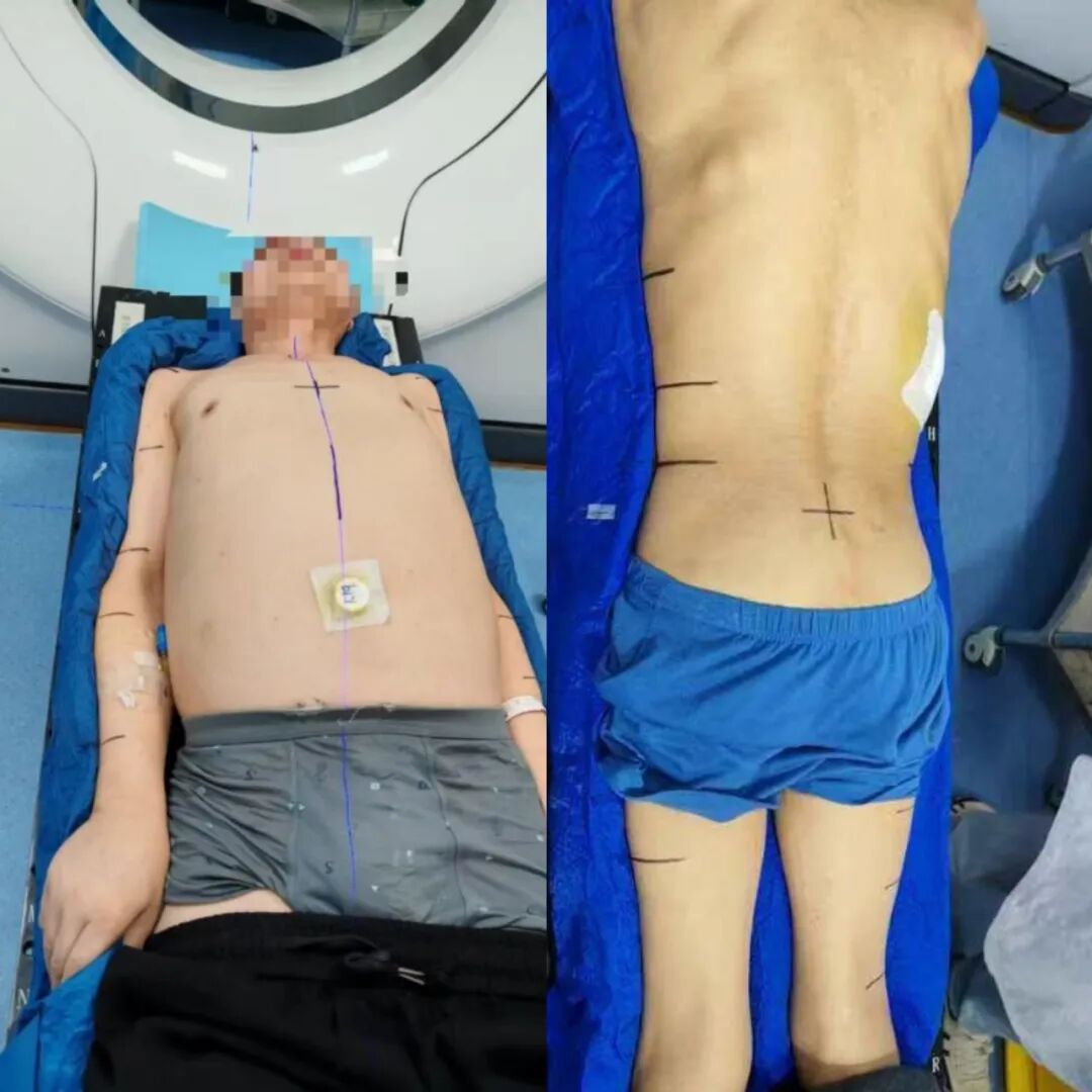 放疗做膜是什么意思【肿瘤中心 健康科普】放射治疗患者体位固定须知_https://www.jmylbn.com_新闻资讯_第5张