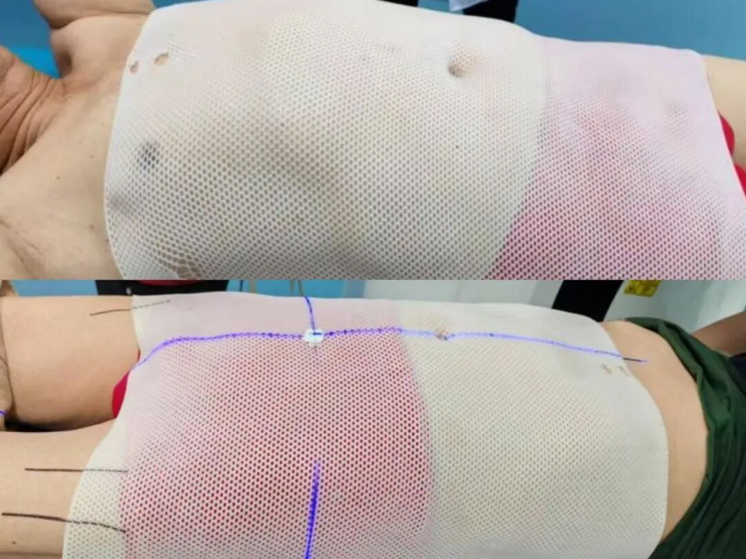 放疗做膜是什么意思【肿瘤中心 健康科普】放射治疗患者体位固定须知_https://www.jmylbn.com_新闻资讯_第4张