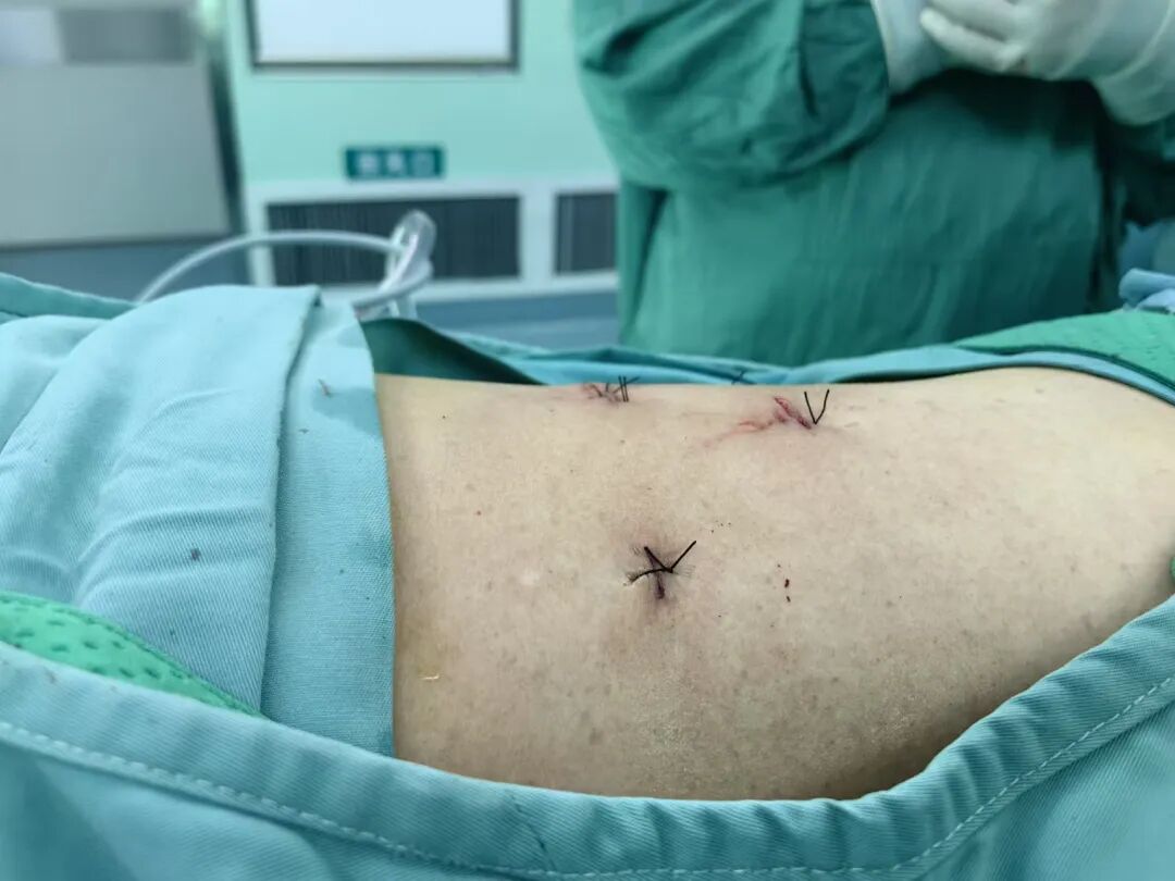 "四免"完全无管化腹腔镜肾上腺肿瘤切除术治疗肾上腺