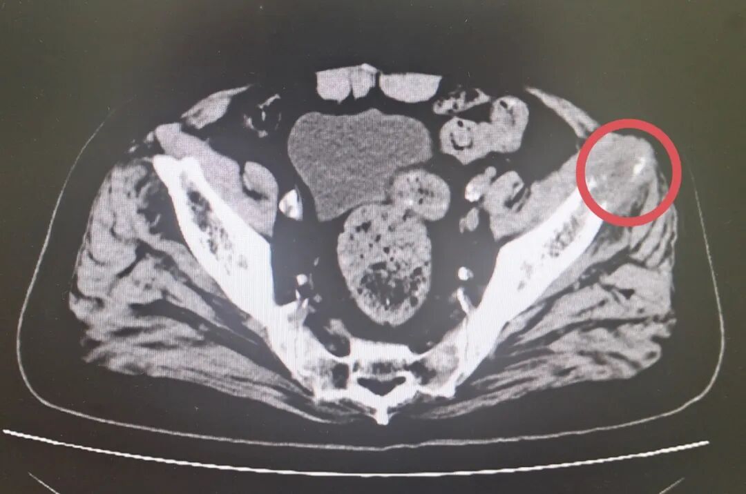 氦氩刀是什么“冰火两重天”，氩氦刀“杀死”肿瘤_https://www.jmylbn.com_新闻资讯_第2张