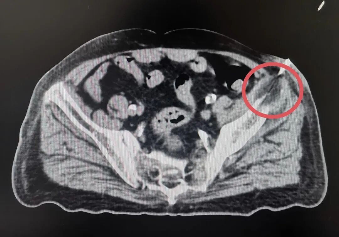 氦氩刀是什么“冰火两重天”，氩氦刀“杀死”肿瘤_https://www.jmylbn.com_新闻资讯_第5张