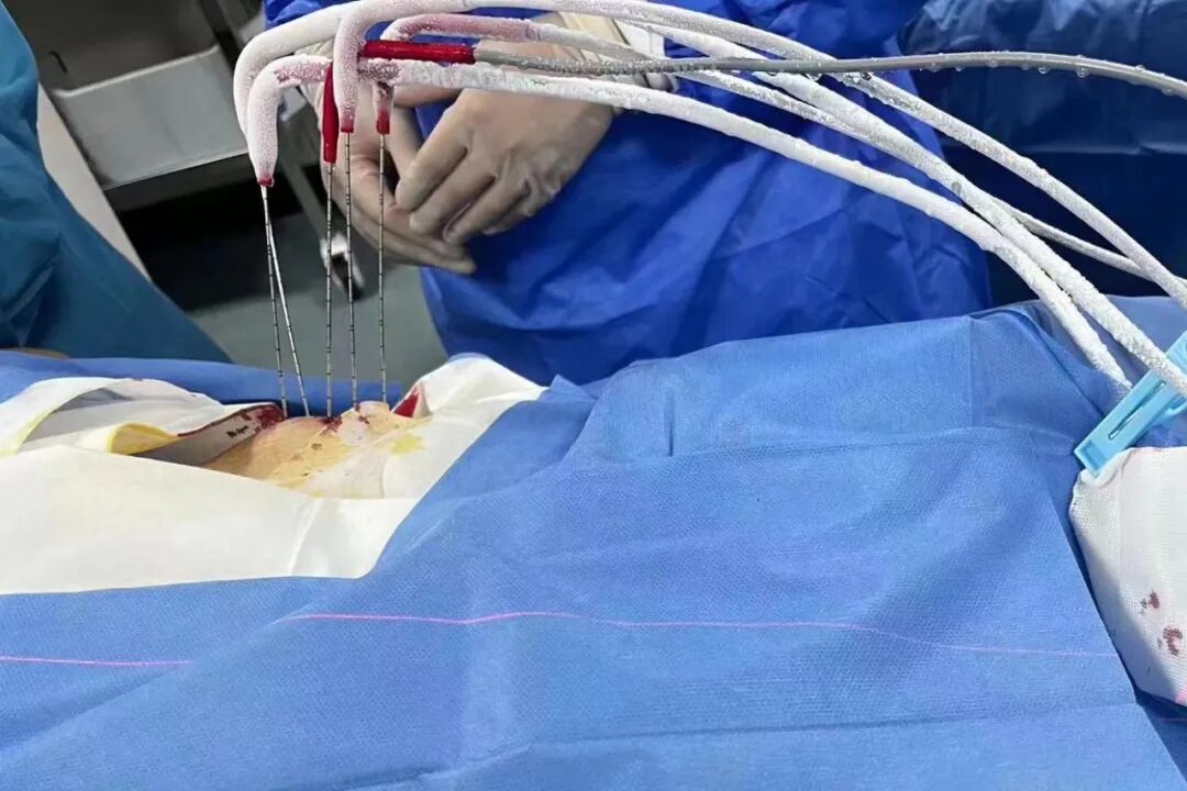 氦氩刀是什么“冰火两重天”，氩氦刀“杀死”肿瘤_https://www.jmylbn.com_新闻资讯_第4张