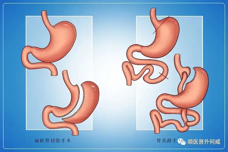 手术减肥_减肥手术有哪些方法_减肥手术后遗症